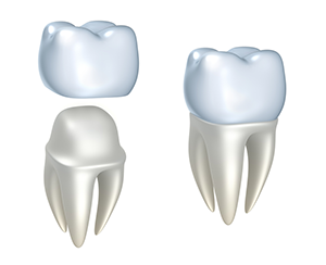 illustration of dental crown assembly single visit crowns Portage, MI